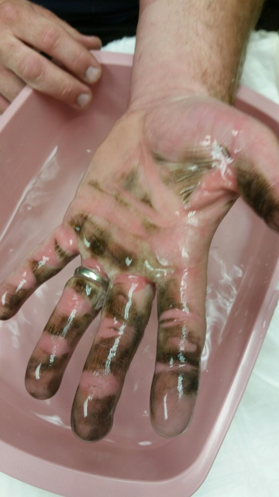 CPSC recalls sparklers after Idahoans burned "It exploded