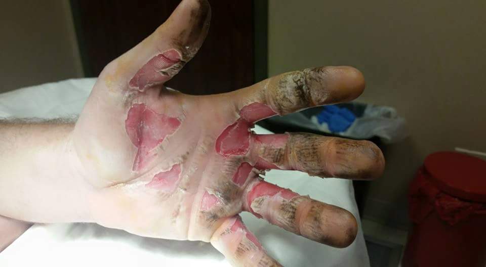 CPSC recalls sparklers after Idahoans burned "It exploded