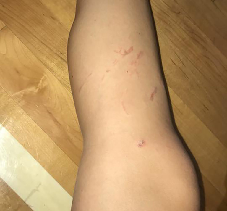 Mother issues warning after blanket severely burns daughter East